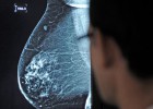 Los cirujanos plásticos sugieren la extirpación tras el tumor de mama