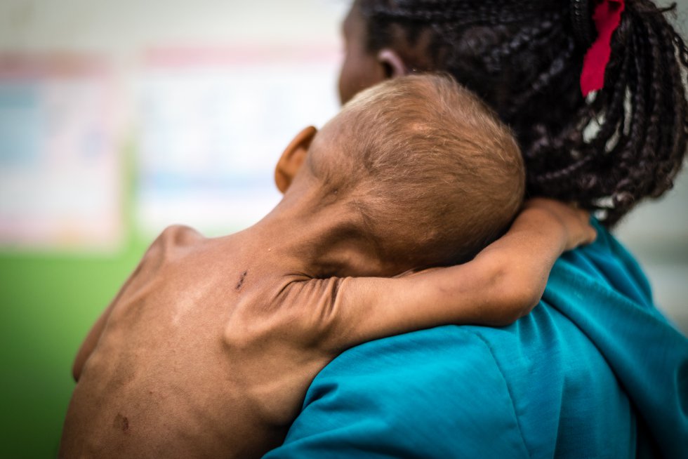 La gravedad de la sequía está poniendo en peligro la vida de los más vulnerables: los niños. Según cifras de Unicef, al menos seis millones de niños en Etiopía se enfrentan a la escasez crítica de alimentos; además, calcula el que  450.000 necesitarán tratamiento contra la desnutrición aguda grave y 2,2 millones de menores y madres padecerán los efectos de la desnutrición aguda moderada.rn