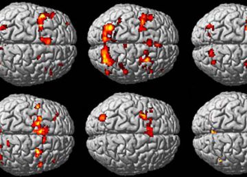 Los lazos genéticos entre las enfermedades del cerebro, al descubierto