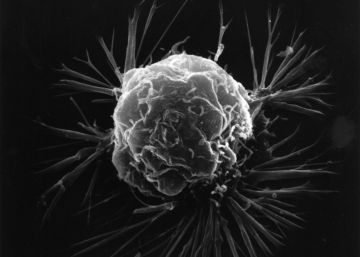Dos fármacos convierten células cancerosas en grasa para frenar la metástasis
