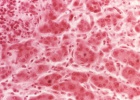 Un fármaco anticolesterol podría ayudar a tratar la hepatitis C