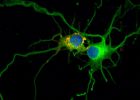 El mal de Alzhéimer avanza neurona a neurona