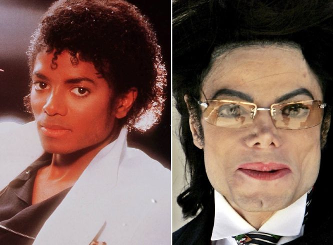 Michael Jackson fue uno de los cantantes que más cirugías se hizo. No solo se respingó la nariz y acentuó la mandíbula (operaciones a las que se sometió en más de una ocasión); el artista se sometió a un tratamiento para blanquear su piel.
