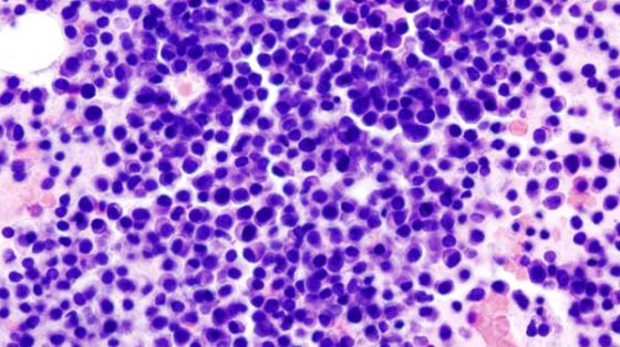 Epidemiologia mieloma multiple chile