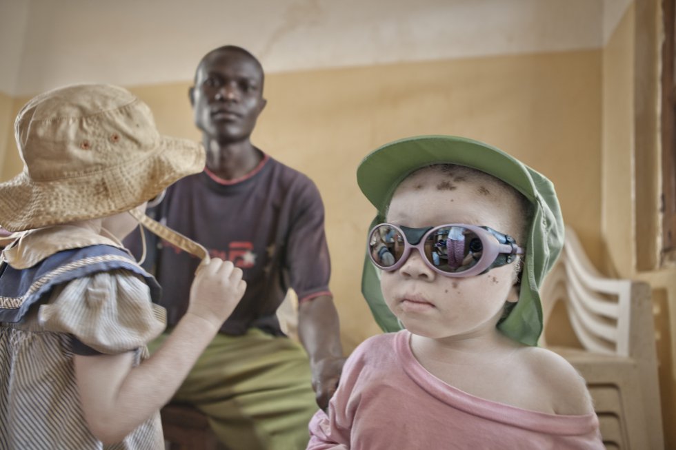 Albinos en Tanzania. Grupo de Dermatología Pedro Jaén