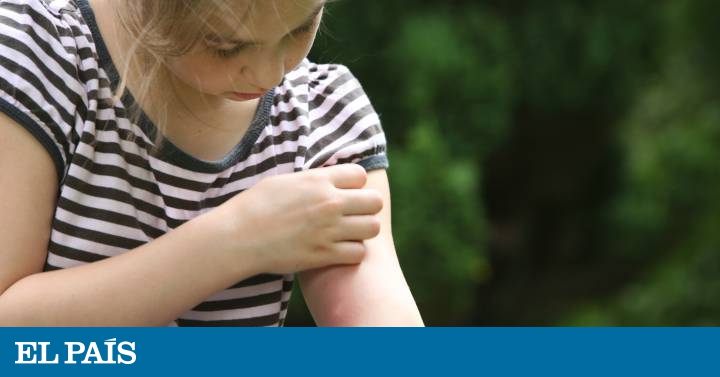 Como curar picadura de pulga en ninos
