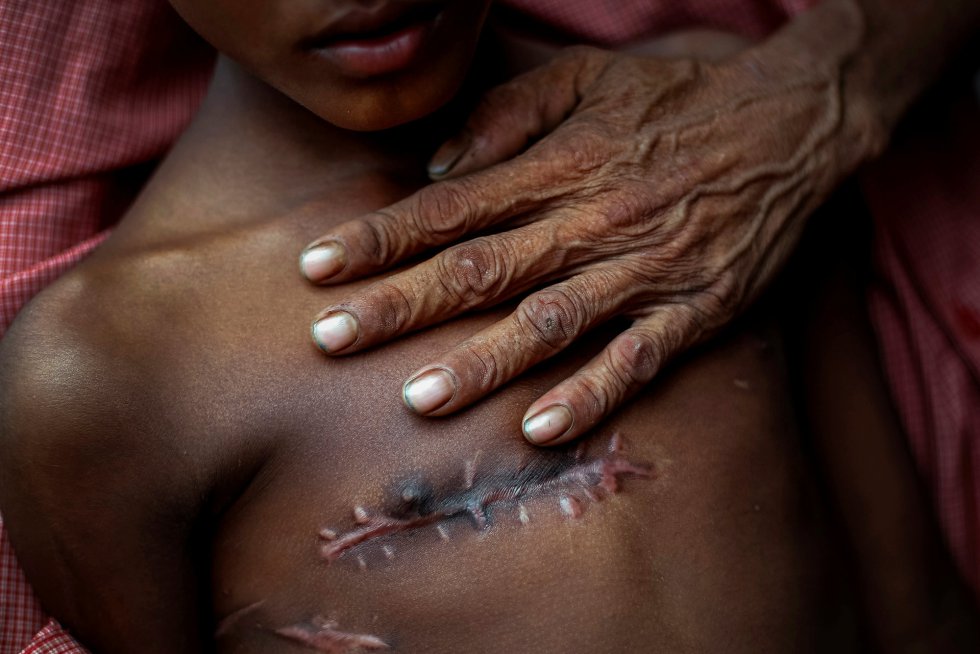Mohammed Shoaib, 7 anos, foi baleado no peito antes de cruzar a fronteira com Mianmar em 5 de novembro de 2017.