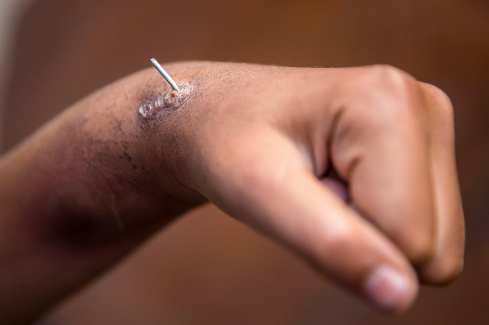 Rafael, 14, mostra um pedaço de fio de metal que sai de uma ferida infectada em sua mão, depois de fraturá-la meses atrás, pulando um muro.