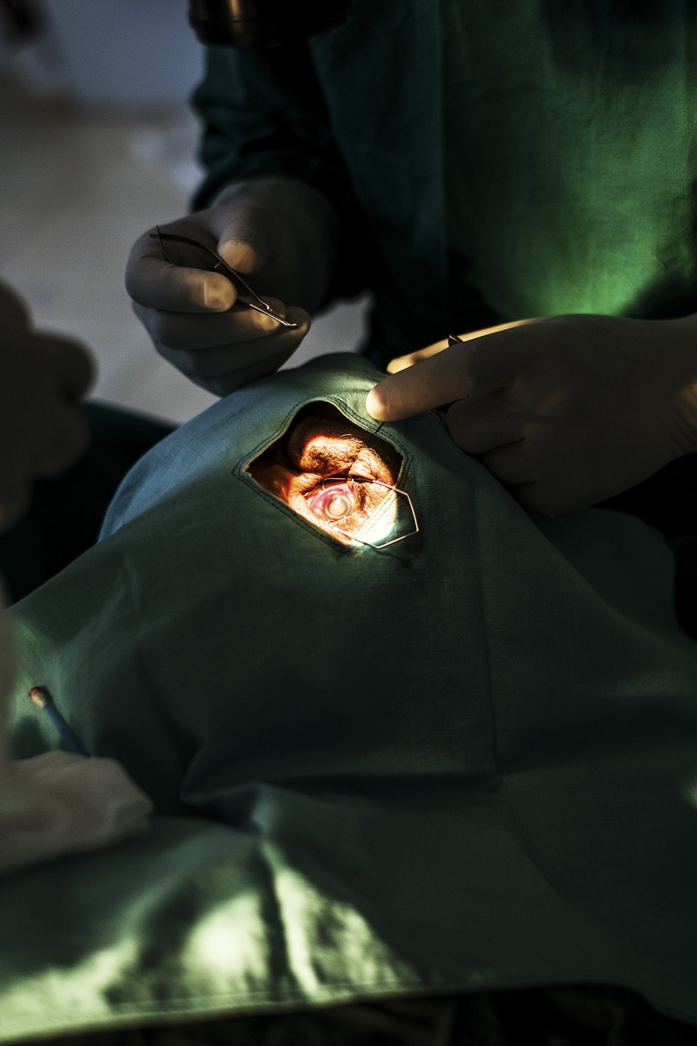Las cataratas y el tracoma son las principales causas de ceguera y discapacidad visual en Etiopía. En la imagen, una operación de cataratas efectuada en el quirófano del Centro de Salud de Wasserà.