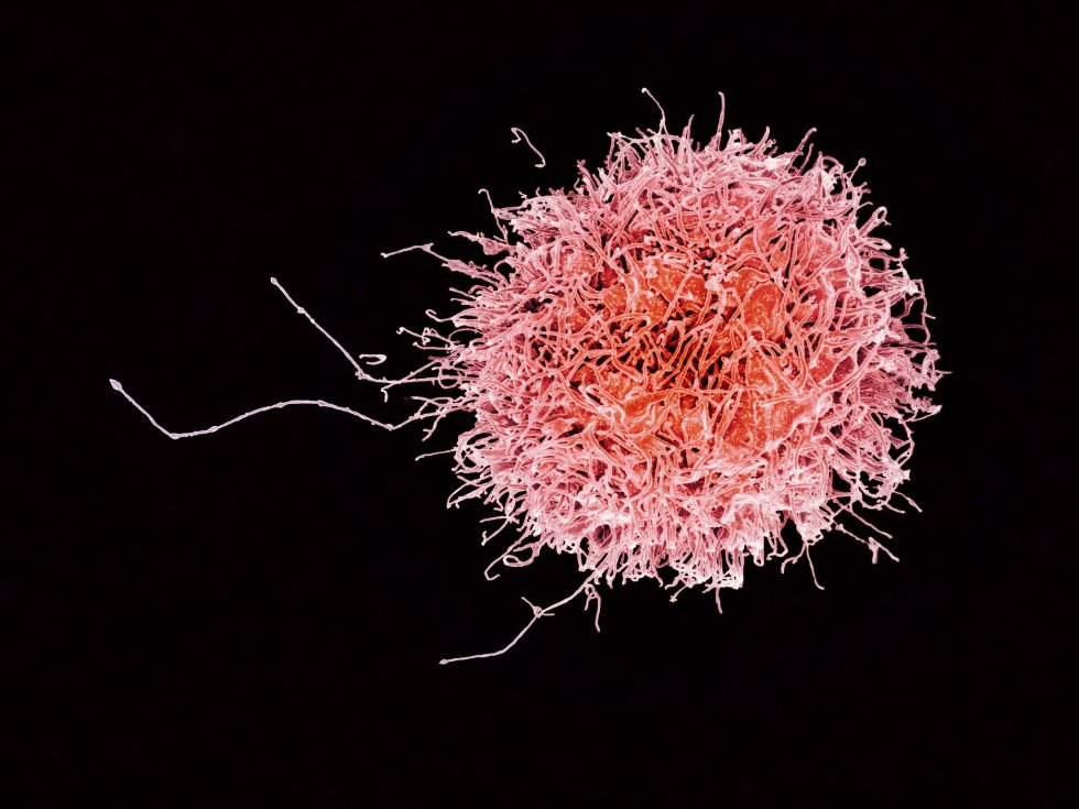 La célula asesina humana (célula NK) es un linfocito que se encarga de luchar contra las infecciones. Es un componente importante para el sistema inmunitario del organismo.