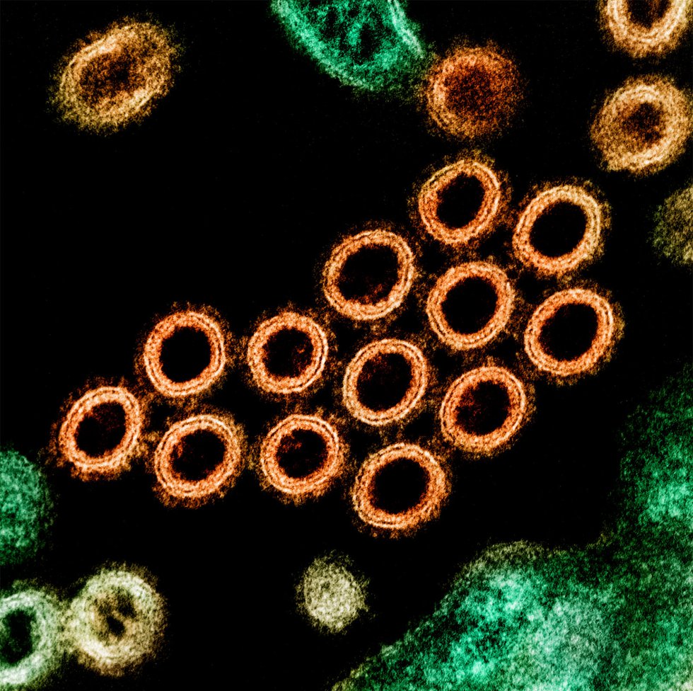 Una sección transversal de partículas de virus de influenza (cepa porcina) encontradas cerca de la superficie de una célula infectada. La primera aparición registrada de lo que se conoce como gripe A fue en 1918 y mató a más de 50 millones de personas. Ha dejado huella ya que vuelve cada año, pero con menor impacto, como una gripe estacional. En 1957, en Asia, una variante de este virus (H2N2) causó la gripe asiática que acabó con la vida de casi un millón de personas. En 2009, volvió un subtipo y dio lugar a la denominada gripe porcina.