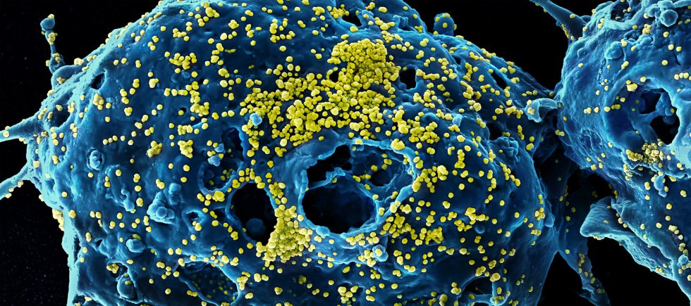 Unas partículas del virus del Síndrome Respiratorio del Medio Oriente (amarillo) unidas a la superficie de una célula infectada. El Mers apareció en Arabia Saudí en 2012 y fue muy letal. El 35% de los pacientes contagiados de este coronavirus, murieron. Los síntomas son los mismos que para la Covid-19: tos, fiebre y problemas respiratorios.