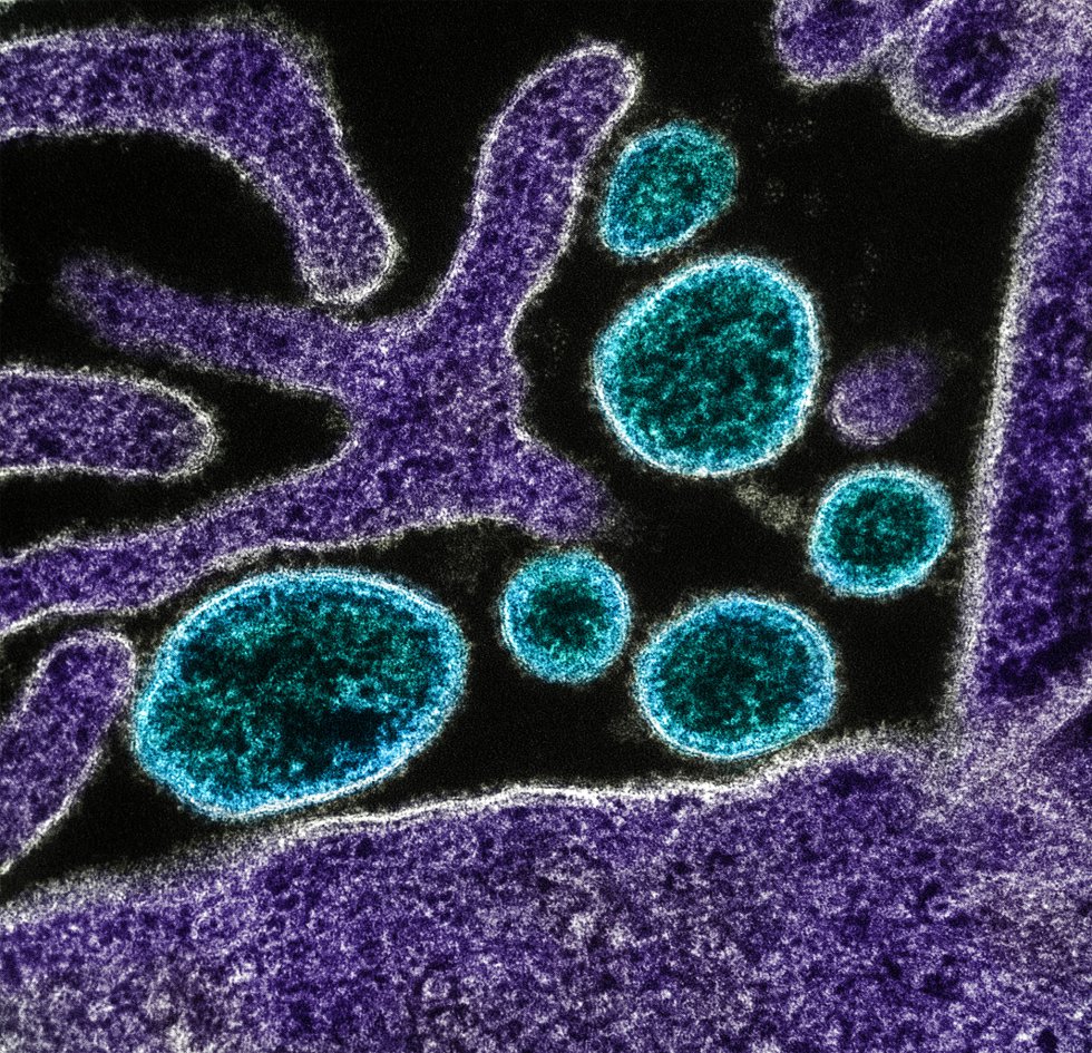 Partículas extracelulares del Virus Nipah cerca de la periferia de una célula infectada. La infección por el virus Nipah (VNi) es una zoonosis que emergió en 1998 en Malasia y ha provocado varios brotes en Asia. Aunque la cifra de infectados no sea muy alta, de pocas decenas de afectados por brote, la OMS estima que la tasa de letalidad varía entre el 40% y el 75% de los casos. El huésped natural del virus es el murciélago frutero de la familia 'Pteropodidae' y puede afectar a los cerdos y otros animales domésticos. Las manifestaciones clínicas van desde un proceso asintomático hasta un síndrome respiratorio agudo o una encefalitis mortal y no hay ninguna vacuna por ahora.