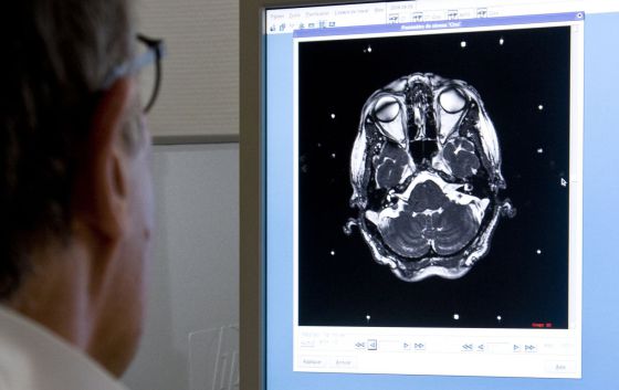 melanoma metastasis cerebral esperanza vida