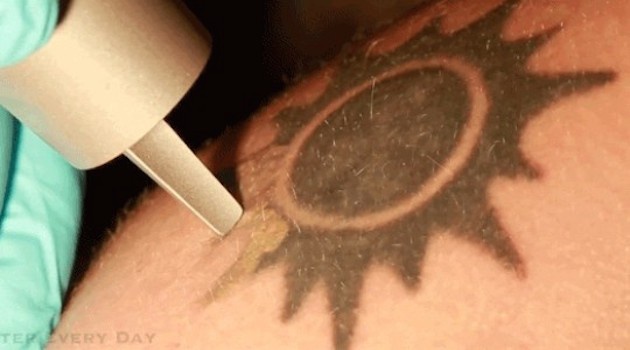 Así se pone (y por eso duele) un tatuaje y así se quita con láser